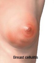 Breast Cellulitis Infection, Picture 0001