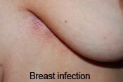 Breast Cellulitis Infection - Picture 0002