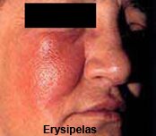 Cellulitis and Erysipelas Pictures 0001