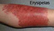 Cellulitis and Erysipelas Pictures 0002