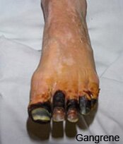 Cellulitis Complications Pictures 0002