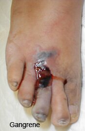 Cellulitis Infection Complications Pictures 0003