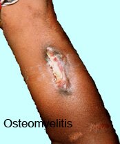 Cellulitis Complications Pictures 0005