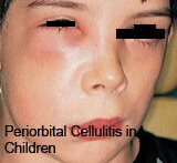 Cellulitis in Children Pictures0001