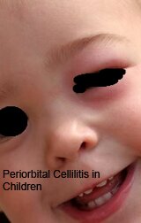 Cellulitis in Children Pictures 0002 