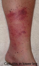 Cellulitis in Lower Leg Pictures 0001