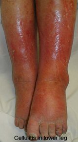 Cellulitis in Lower Leg Pictures 0002