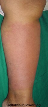 Cellulitis in Lower Leg Pictures 0003