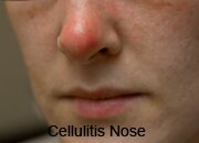 Nose Cellulitis Pictures 0002