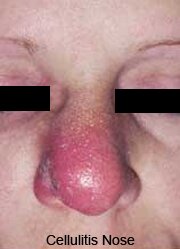 Nose Cellulitis Pictures 0001