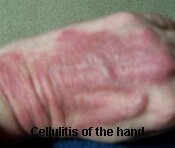 Cellulitis of the Hand Pictures 0002