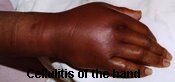 Cellulitis of the Hand Pictures 0003