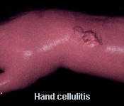 Cellulitis of the Hand Pictures 0004