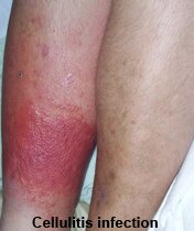 cellulitis skin infection pictures0001