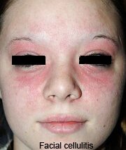 Facial Cellulitis Pictures 0001