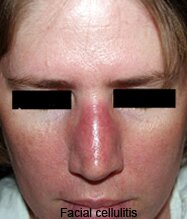 Facial Cellulitis Pictures 0002