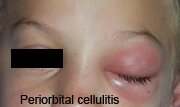 Periorbital (Preseptal) Cellulitis Pictures 0003